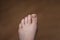 Close-up of the toes of a woman with ingrown toenails with a fungal infection. The concept of nail care and treatment of