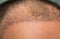 Close up top view of a man`s head with hair transplant surgery with a receding hair line