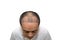 Close up top view of a man`s head with hair transplant surgery with a receding hair line