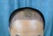 Close up top view of a man`s head with hair transplant surgery with a receding hair line