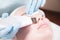 Close-up ultrasound face peel at the beautician. Beautician squeezes acne on the patient`s forehead with a medical