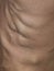 Close up of varicaose veins