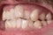 Close-up of very crooked teeth in an adult bearded guy. Not the right bite. Not healthy teeth. Violation of the position of the