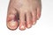 Close up view of damaged foot with bruise big toe. Injuries concept