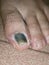 Close up view of toenail flipped and turned black
