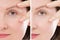 Close up woman face before after lifting injection. Middle age lady before-after wrinkled skin, eye bags, nasolabial folds. Face