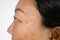 Close-up of woman half face with problems of acne inflammation