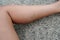 close up woman left leg with bruise wound from accident