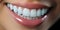Close up woman smile. Teeth whitening. Dental care