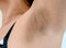 Close up Women armpit with problem black armpit. Dark and wrinkle armpit from deodorant allergic. Image for skin care and beauty c