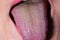 Close-up of a yellow coating on the girl& x27;s tongue. Sign of diseases of the gastrointestinal tract, liver and gallbladder