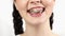 Close-up of young smiling Caucasian woman showing dirty teeth. Concept of orthodontic treatment and hygiene