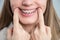 Close-up of a young woman's smile with metal braces on her teeth. Correction of bite