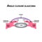 Closed angle glaucoma. A common type of glaucoma. The anatomical structure of the eye. Infographics. Vector illustration