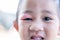 Closed Asian kid little girl eye with sty