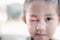 Closed Asian kid little girl eye with sty