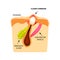 Closed comedones. white heads acne. The structure of the skin. Infographics. Vector illustration on isolated background