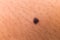 Closed up of a mole of a teenager