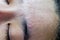 Closeup acne face women
