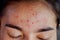 Closeup acne on forehead of Asian woman teen, face with rash skin allergic to cosmetics