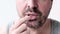 Closeup of adult middle aged bearded man lubricates his lips with a moisturizing cream, herpes treatment