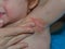 Closeup of Allergy in children in the armpit, mom rubs the cure