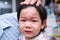 Closeup of Asian boy face sustained a forehead injury from a fall. A 2-3 year old child cries from the pain. A bulging head baby.