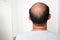 Closeup of an Asian male seen from behind with half-bald hair against a white background