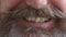 Closeup of bad teeth and crooked incisors in need of orthodontic repair and braces treatment. Overcrowded mouth and