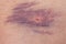 Closeup of big bruise over white skin