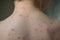Closeup of boys back full of blisters