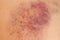 Closeup Bruise on leg skin