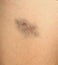 Closeup Bruise on wounded woman\'s leg skin