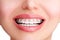 Closeup Ceramic and Metal Braces on Teeth. Beautiful Female Smile with Self-ligating Braces. Orthodontic Treatment...