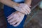 Closeup of Female Hands With Vitiligo Disease