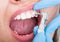 Closeup of female patient having teeth examination