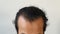 Closeup the front of head lose hair of asian man. Glabrous as V shape