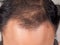 closeup of hair lose