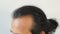 Closeup the beside of head lose hair of asian man. Glabrous as V shape