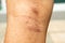 Closeup image of a male body suffering from chronic skin rash. Food allergy rash