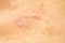 Closeup image of a male body suffering from chronic skin rash. Food allergy rash