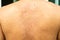 Closeup image of a male body suffering from chronic skin rash. Food allergy rash