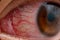 Closeup of irritated or infected red bloodshot eye - conjunctivitis. Red eye of woman, conjunctivitis eye, allergy or after cry