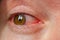 Closeup irritated infected red bloodshot eyes, conjunctivitis