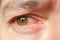 Closeup irritated infected red bloodshot eyes, conjunctivitis