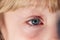 Closeup of irritated red bloodshot eye - conjunctivitis