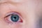 Closeup of irritated red bloodshot eye - conjunctivitis