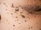 Closeup of large brown nevus moles on human body skin