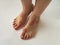 Closeup of the legs of a woman suffering from chronic psoriasis on a white background. Closeup of rash and scaling on the patient