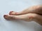 Closeup of the legs of a woman suffering from chronic psoriasis on a white background. Closeup of rash and scaling on the patient